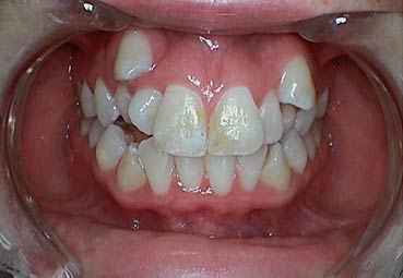Six-Month-Smile-Lancaster-OH-Kristina-Before2