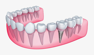 Dental Implants | Friendly Dental | Lancaster OH
