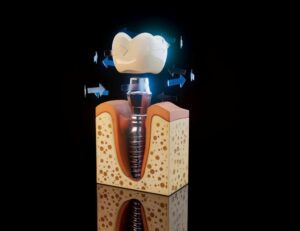 Learn dental implant basics and how they can restore your smile