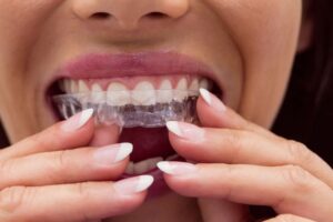 Find out who is a good provider of Invisalign in Lancaster.